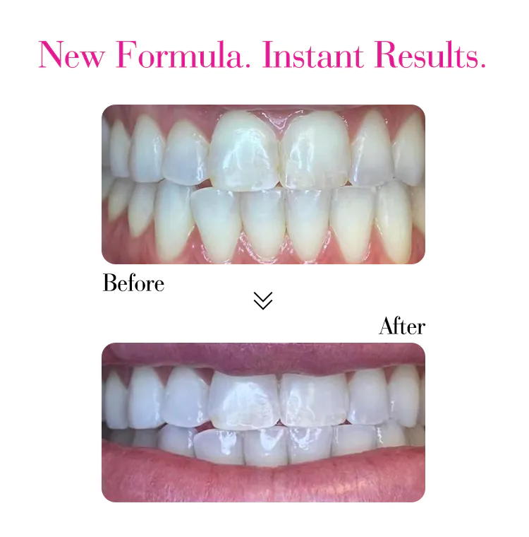 GlorySmile pap teeth whitening gel company for teeth