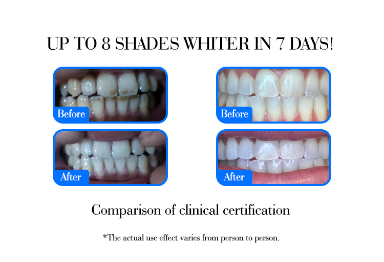 GlorySmile Custom ODM pap teeth whitening gel company for whitening teeth-4