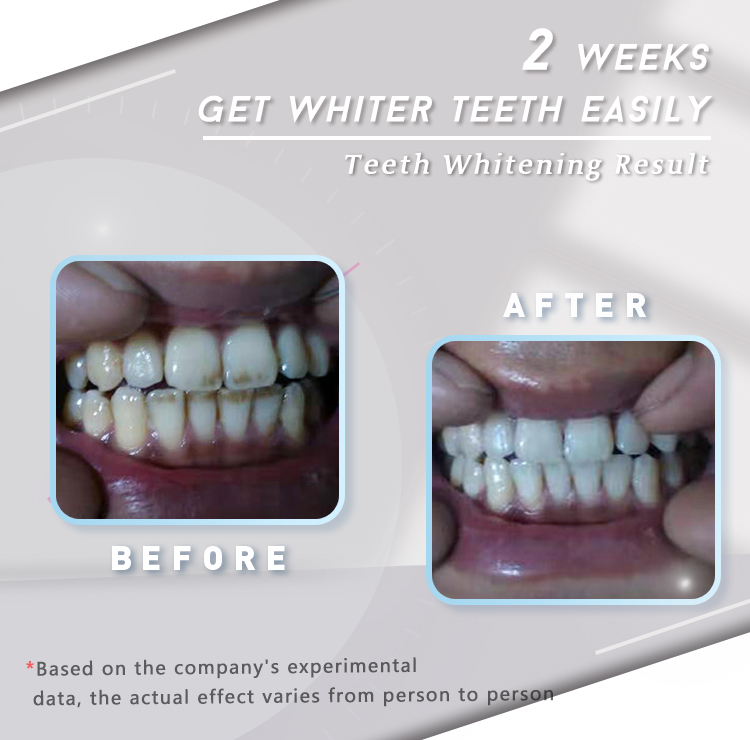 GlorySmile Bulk buy ODM 3d white teeth whitening strips for business for whitening teeth-3