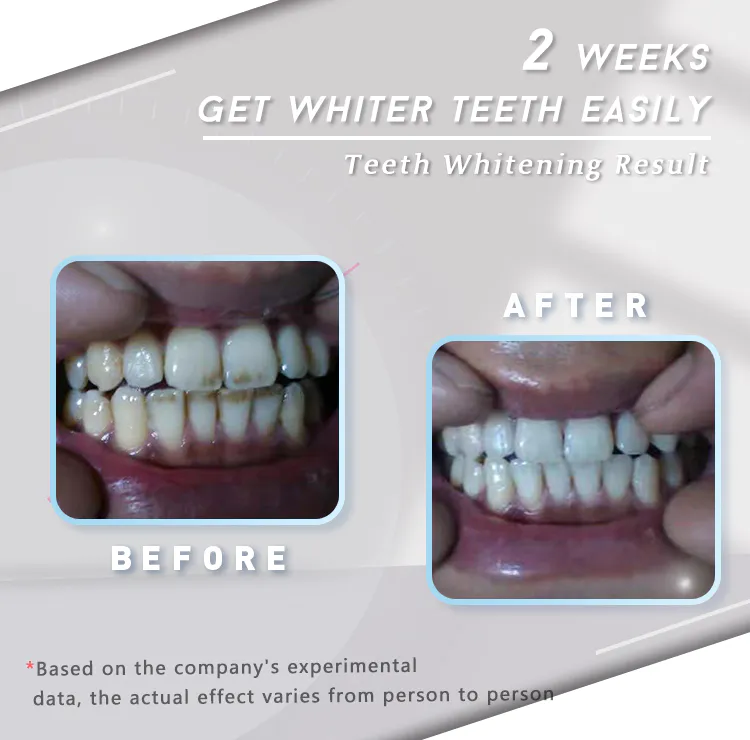 ODM professional whitening strips company for whitening teeth