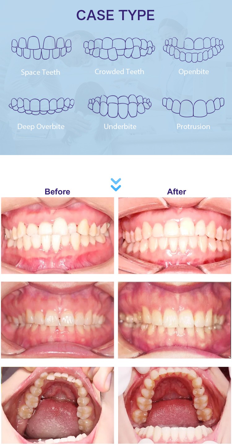 Bulk purchase custom clear teeth aligners Supply for whitening teeth-5