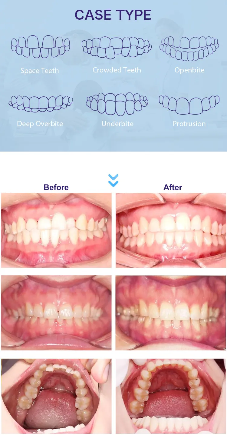 GlorySmile Custom ODM braces and aligners manufacturers for teeth