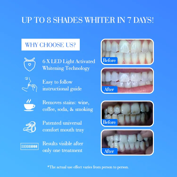 GlorySmile OEM high quality take home teeth whitening kit supplier for whitening teeth